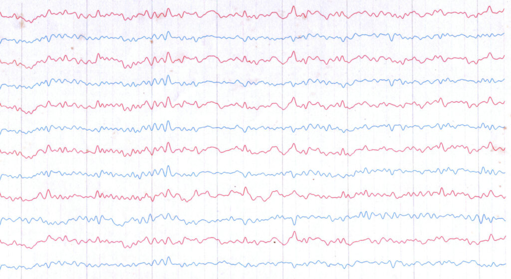 A sample EEG scan showing a series of jagged lines.